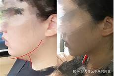 内分泌失调痘痘4、保持良好的睡眠人的大脑在深度睡眠中会有